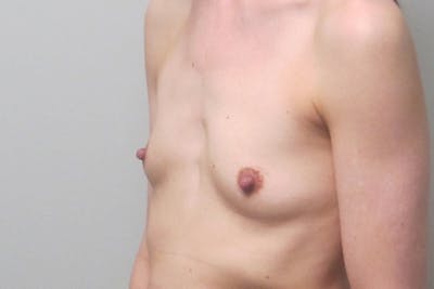 Breast Augmentation Before & After Gallery - Patient 215869 - Image 1