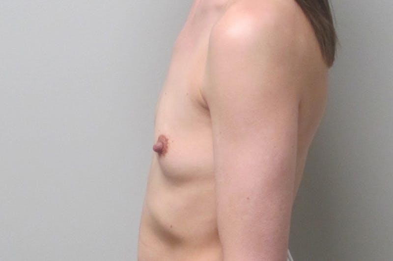 Breast Augmentation Before & After Gallery - Patient 215869 - Image 3