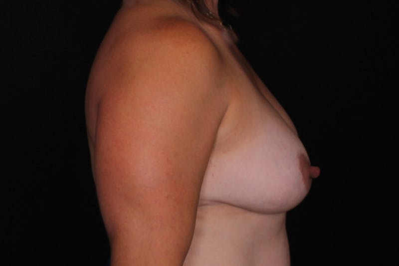 Breast Augmentation Before & After Gallery - Patient 284658 - Image 5