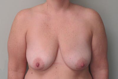 Breast Augmentation with Lift Before & After Gallery - Patient 338452 - Image 1
