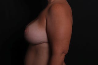 Breast Augmentation with Lift Before & After Gallery - Patient 338452 - Image 6