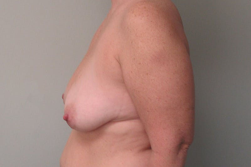 Breast Augmentation with Lift Before & After Gallery - Patient 338452 - Image 5