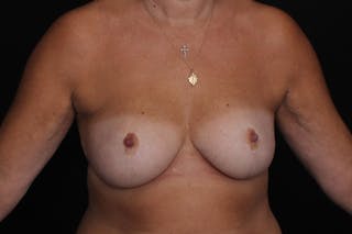 Breast Reduction Before & After Gallery - Patient 166466 - Image 2