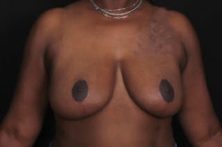 Breast Reduction Before & After Gallery - Patient 259636 - Image 2