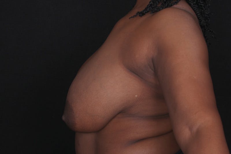 Breast Reduction Before & After Gallery - Patient 259636 - Image 5