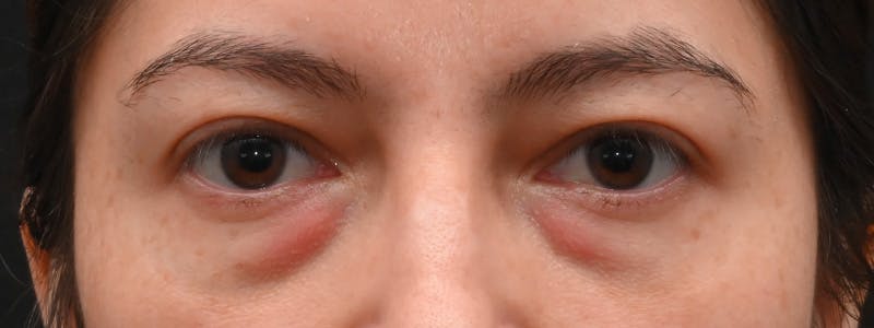Eyelid Surgery Before & After Gallery - Patient 681517 - Image 3