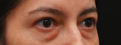 Eyelid Surgery Before & After Gallery - Patient 681517 - Image 1