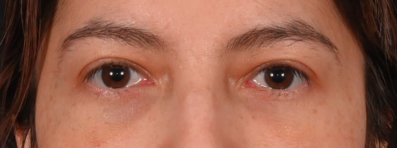 Eyelid Surgery Before & After Gallery - Patient 681517 - Image 4