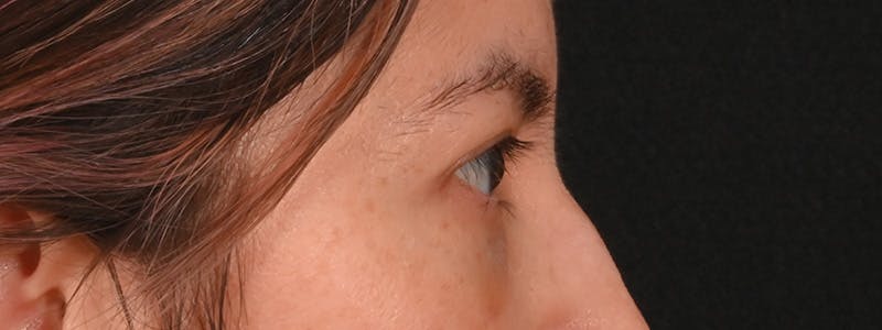Eyelid Surgery Before & After Gallery - Patient 681517 - Image 6