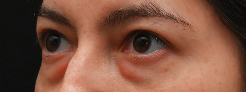 Eyelid Surgery Before & After Gallery - Patient 681517 - Image 7