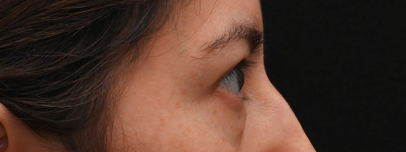 Eyelid Surgery Before & After Gallery - Patient 681517 - Image 5