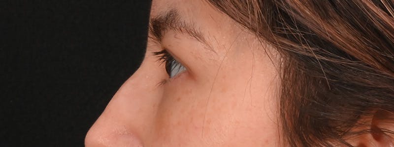 Eyelid Surgery Before & After Gallery - Patient 681517 - Image 10