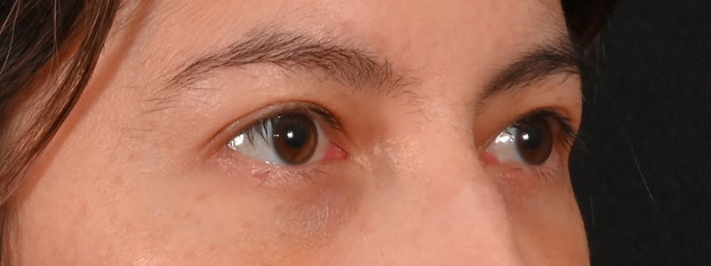 Eyelid Surgery Before & After Gallery - Patient 681517 - Image 2