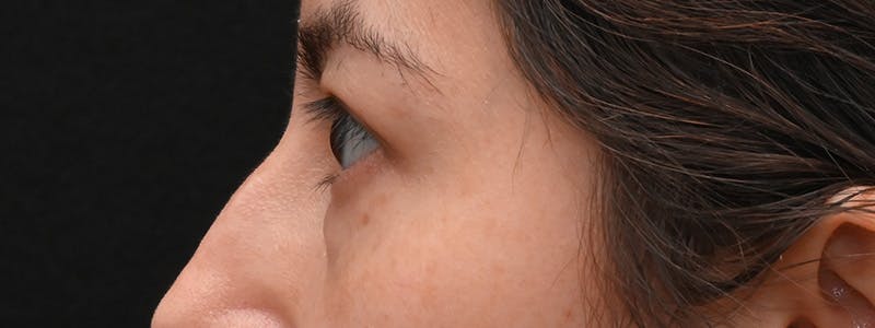 Eyelid Surgery Before & After Gallery - Patient 681517 - Image 9