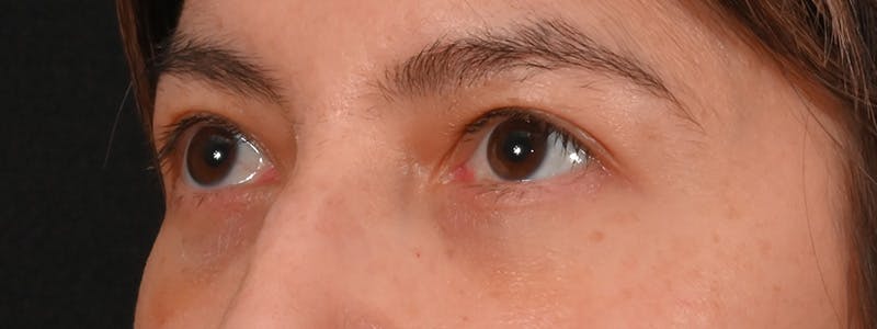 Eyelid Surgery Before & After Gallery - Patient 681517 - Image 8