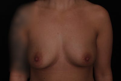 Breast Augmentation Before & After Gallery - Patient 347225 - Image 1