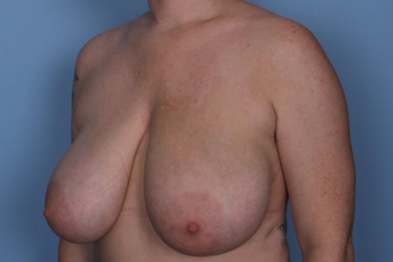Breast Reduction Before & After Gallery - Patient 185697 - Image 3