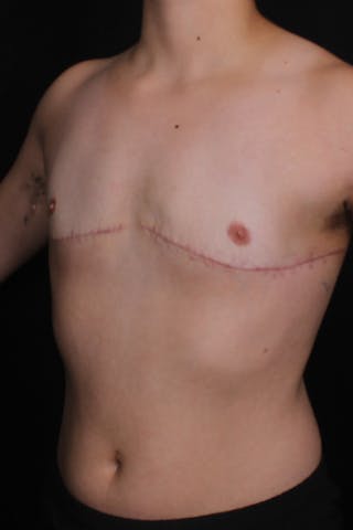 FTM Top Surgery Before & After Gallery - Patient 386432 - Image 4