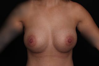 Breast Augmentation Before & After Gallery - Patient 347225 - Image 2
