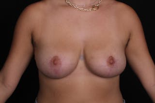 Breast Reduction Before & After Gallery - Patient 350635 - Image 2