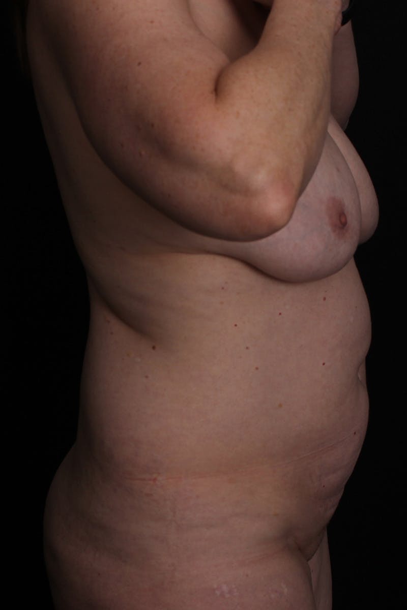 Breast Lift Before & After Gallery - Patient 139326 - Image 5