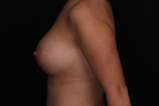 Breast Augmentation Before & After Gallery - Patient 347225 - Image 6