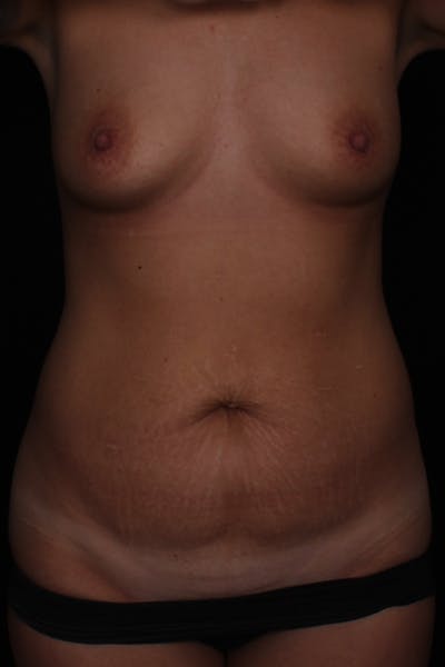 Abdominoplasty Before & After Gallery - Patient 115888 - Image 1
