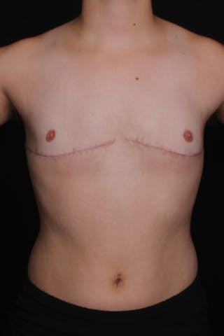 FTM Top Surgery Before & After Gallery - Patient 386432 - Image 2