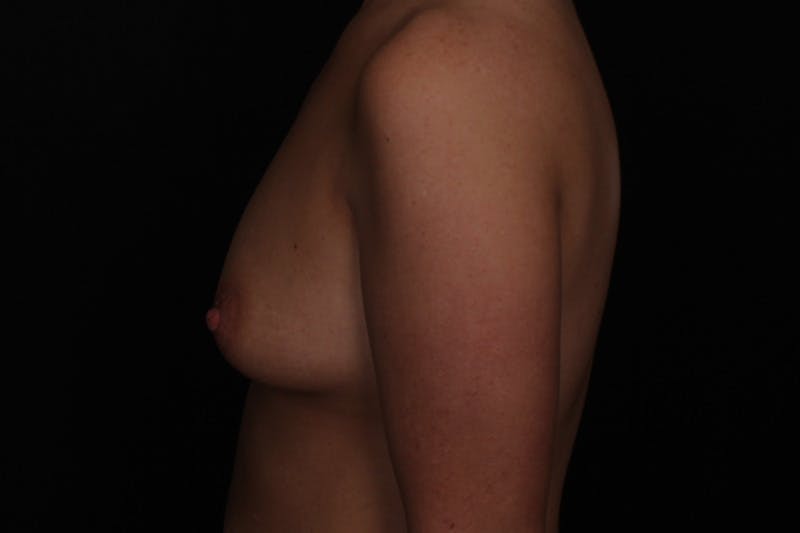 Breast Augmentation Before & After Gallery - Patient 347225 - Image 5