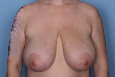 Breast Reduction Before & After Gallery - Patient 185697 - Image 1
