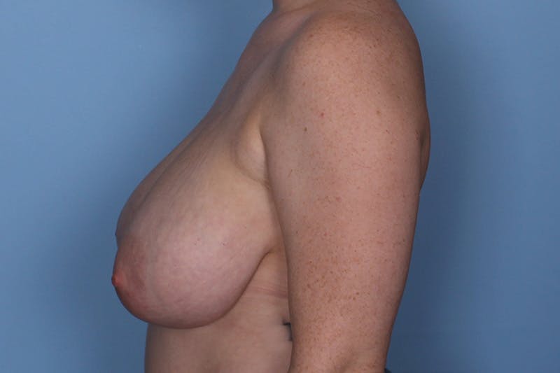 Breast Reduction Before & After Gallery - Patient 185697 - Image 5