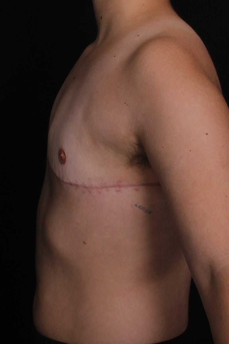 FTM Top Surgery Before & After Gallery - Patient 386432 - Image 6