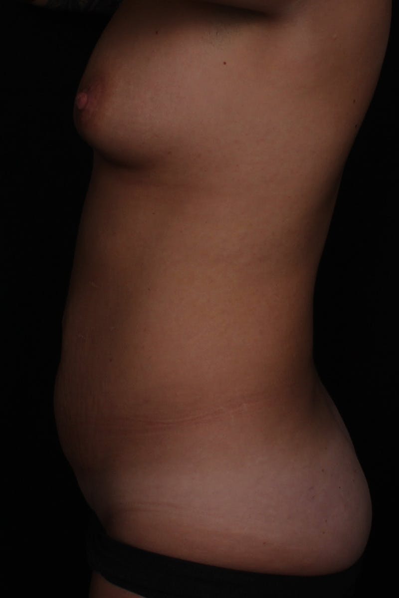 Abdominoplasty Before & After Gallery - Patient 115888 - Image 5