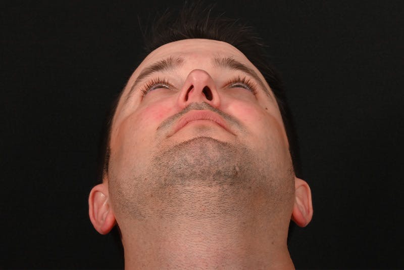 Rhinoplasty Before & After Gallery - Patient 279160 - Image 3