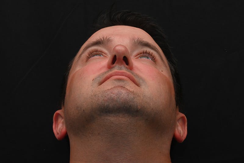 Rhinoplasty Before & After Gallery - Patient 279160 - Image 4