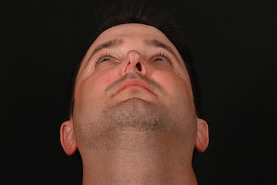 Rhinoplasty Before & After Gallery - Patient 279160 - Image 1