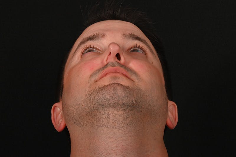 Rhinoplasty Before & After Gallery - Patient 279160 - Image 1