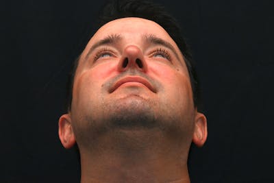 Rhinoplasty Before & After Gallery - Patient 279160 - Image 2