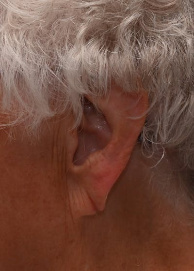 Earlobe Repair Before & After Gallery - Patient 146191 - Image 1