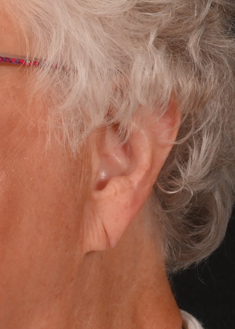 Earlobe Repair Before & After Gallery - Patient 146191 - Image 3