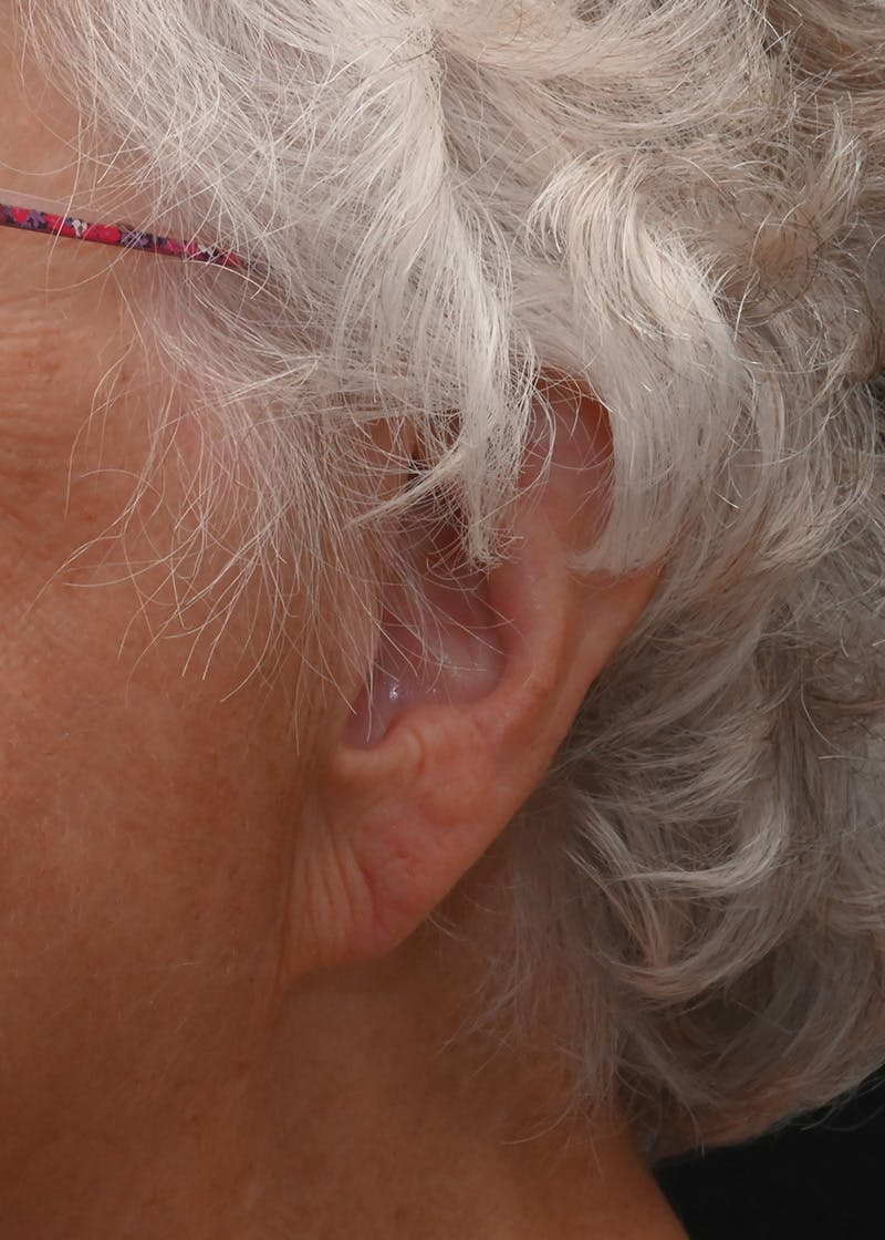 Earlobe Repair Before & After Gallery - Patient 146191 - Image 4