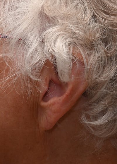 Earlobe Repair Before & After Gallery - Patient 146191 - Image 2