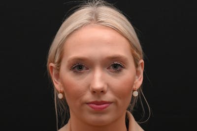 Rhinoplasty Before & After Gallery - Patient 157160 - Image 1