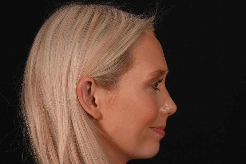 Rhinoplasty Before & After Gallery - Patient 157160 - Image 8