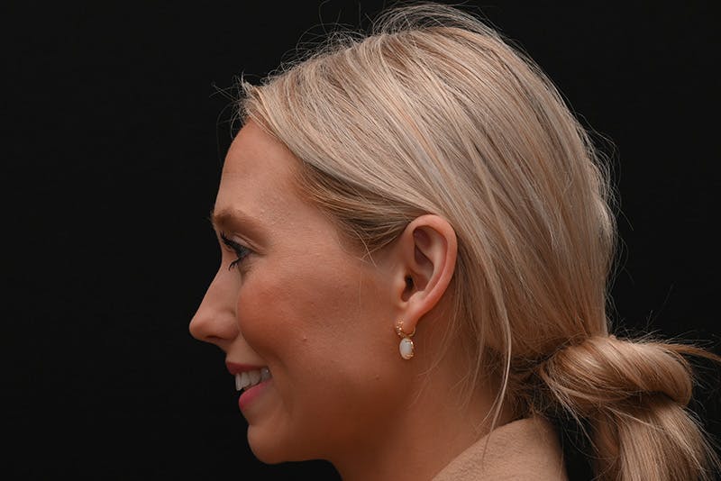 Rhinoplasty Before & After Gallery - Patient 157160 - Image 11