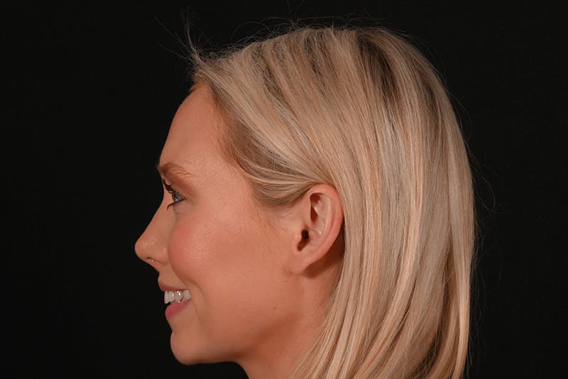 Rhinoplasty Before & After Gallery - Patient 157160 - Image 12
