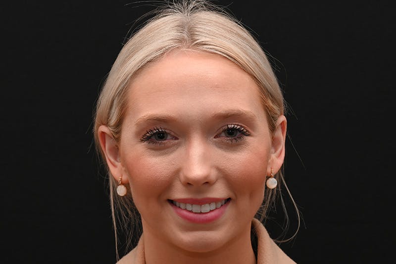 Rhinoplasty Before & After Gallery - Patient 157160 - Image 3