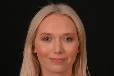 Rhinoplasty Before & After Gallery - Patient 157160 - Image 2