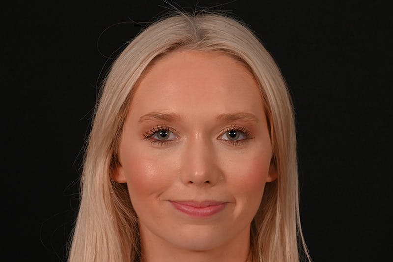 Rhinoplasty Before & After Gallery - Patient 157160 - Image 2