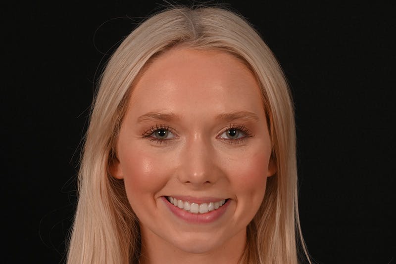 Rhinoplasty Before & After Gallery - Patient 157160 - Image 4